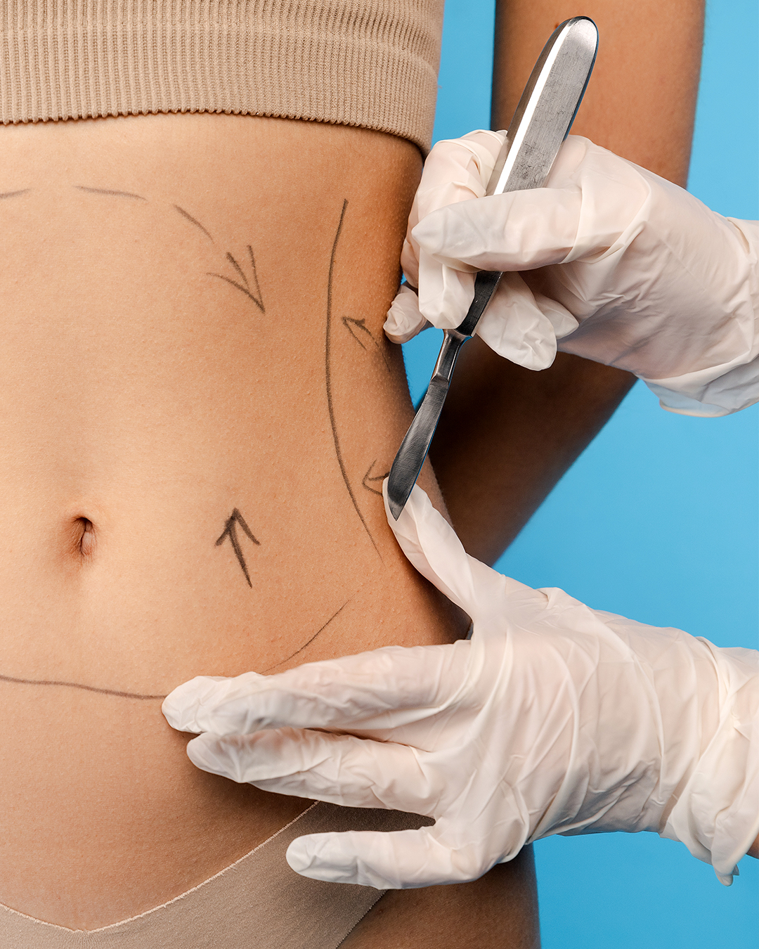 Illustration du déroulement d’une abdominoplastie en Tunisie montrant les étapes chirurgicales : incision, retrait de l’excès de peau et resserrement des muscles.