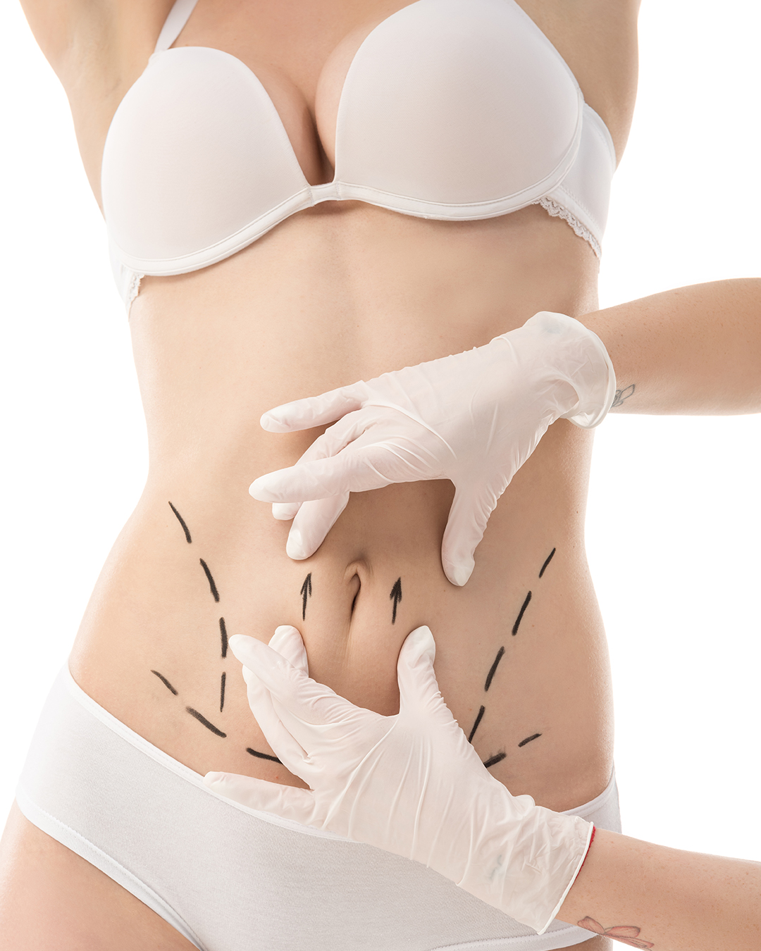 Illustration explicative de l’abdominoplastie en Tunisie, une chirurgie esthétique du ventre qui retire l’excès de peau et de graisse pour obtenir un abdomen plat.