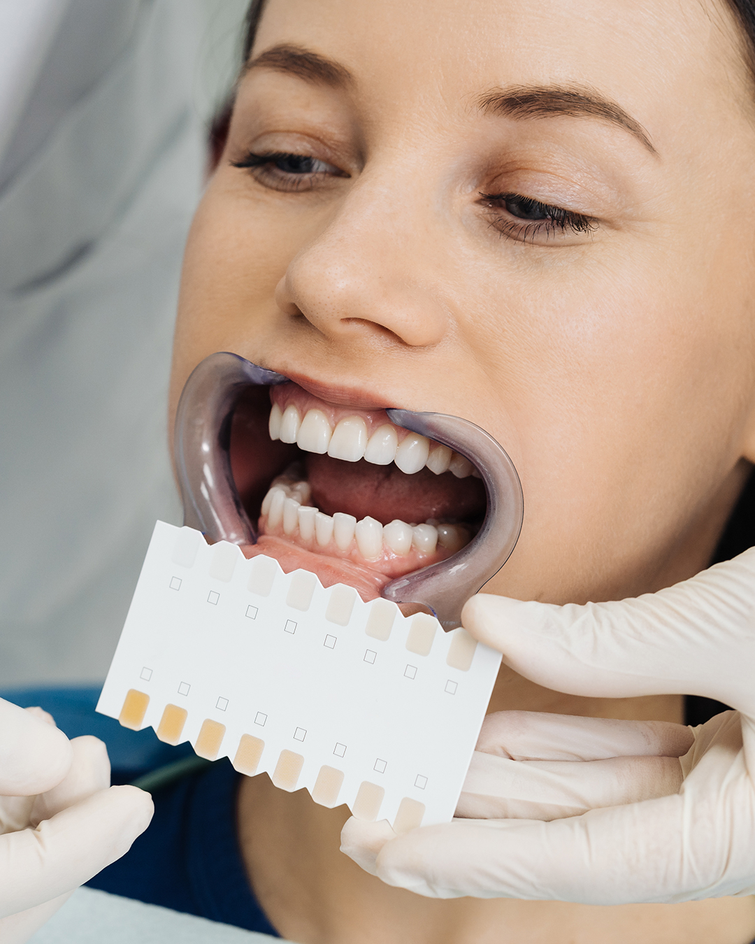 Bridges en céramique zircone en Tunisie avec Trivamed, une solution esthétique, durable et biocompatible pour remplacer les dents manquantes