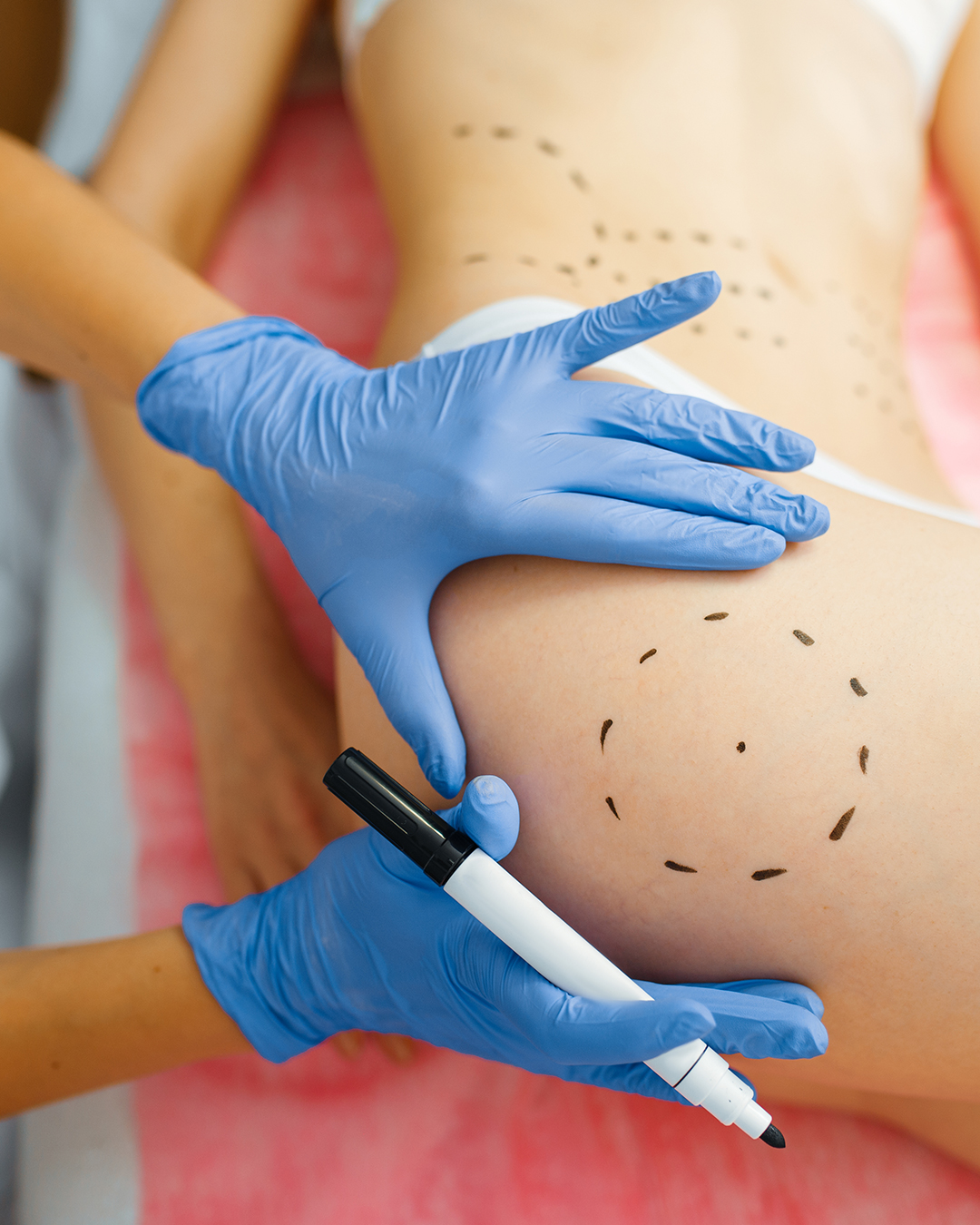 Lipofilling des fesses - alternative naturelle aux implants en Tunisie