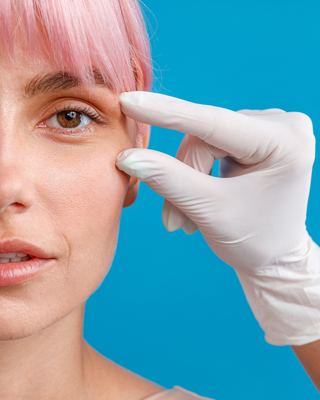 Patiente avant et après une blépharoplastie en Tunisie pour corriger les paupières tombantes et les poches sous les yeux.