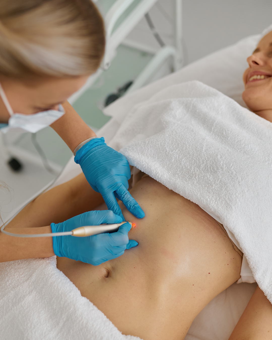 Patiente avant et après une liposuccion en Tunisie réalisée par les chirurgiens esthétiques de Trivamed.