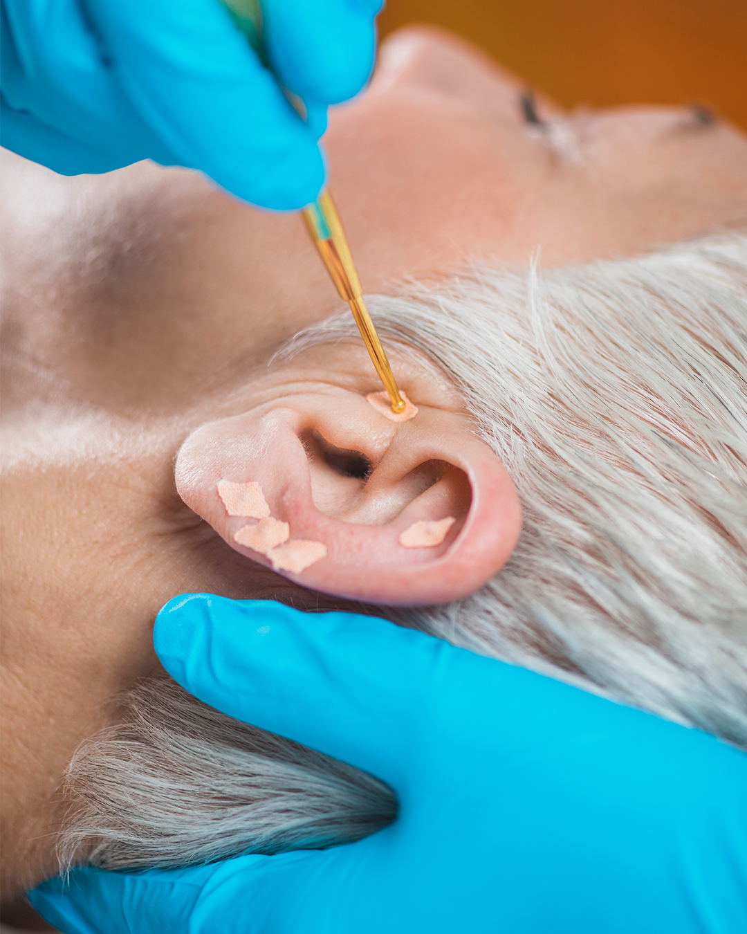 Chirurgie esthétique des oreilles décollées en Tunisie pour corriger la forme et la symétrie avec Trivamed.